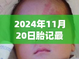 最新胎记治疗方法全面步骤指南（2024年11月版）