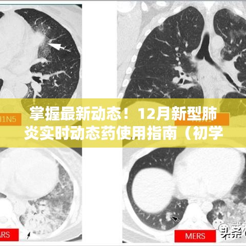 掌握最新动态！全面解读，新型肺炎药物使用指南（初学者进阶版）